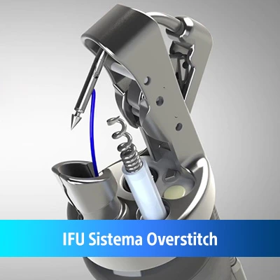 gastroplastia-endosccpica