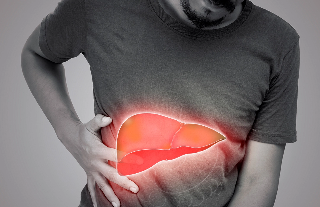 Tudo o que você precisa saber sobre obesidade e esteatose hepática não-alcoólica 